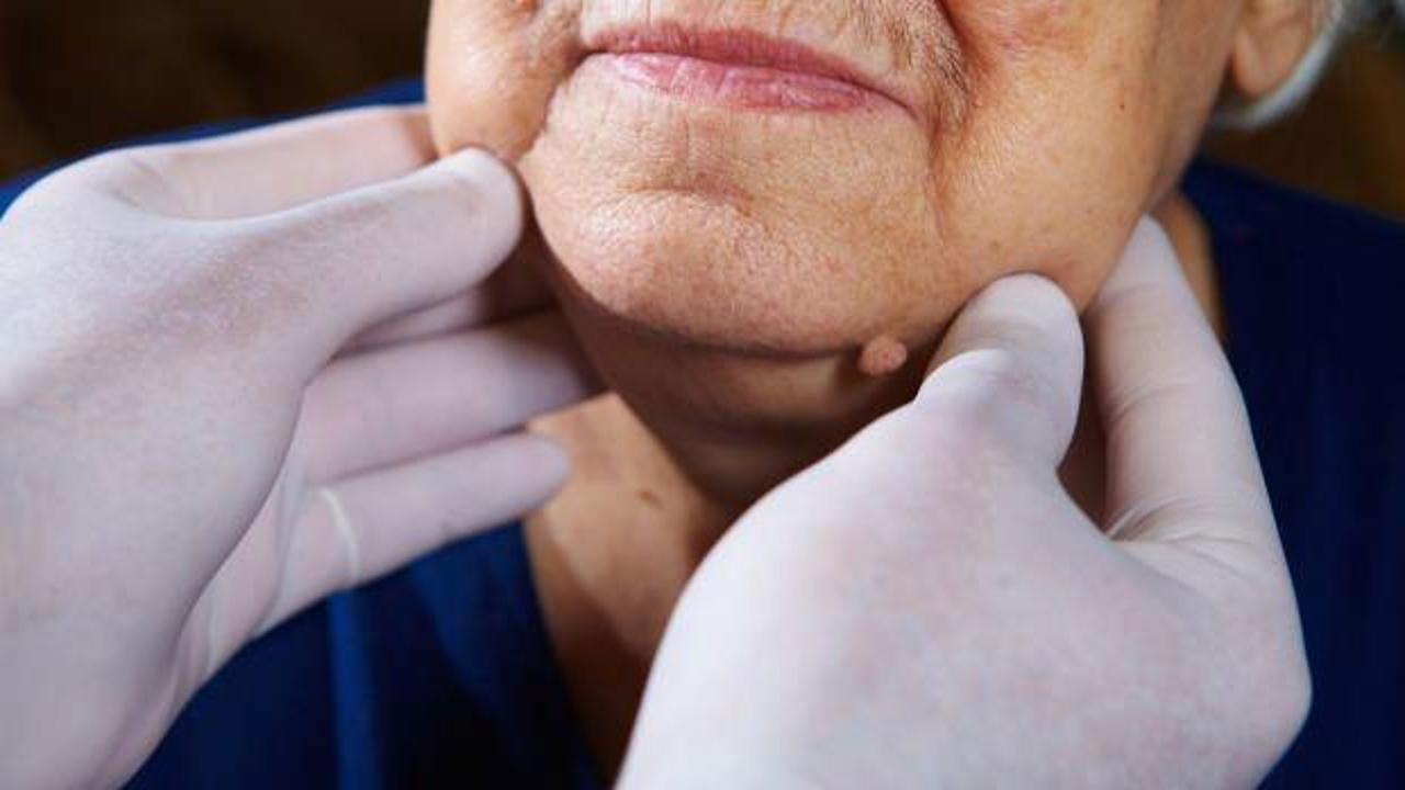 Lenf kanseri nedir, lenfoma kanseri belirtileri nelerdir? Lenf kanseri ölümcül müdür?