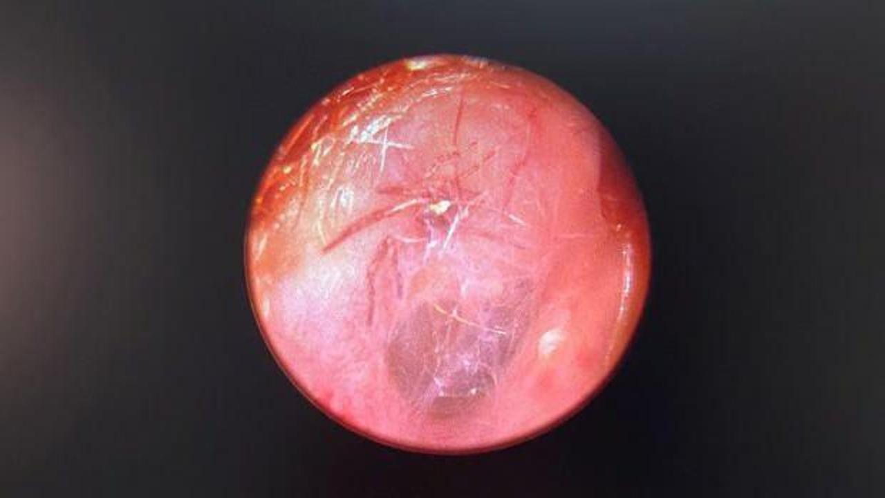 Yaşlı kadının kulağından operasyonla çıkarılan örümcek doğaya salındı