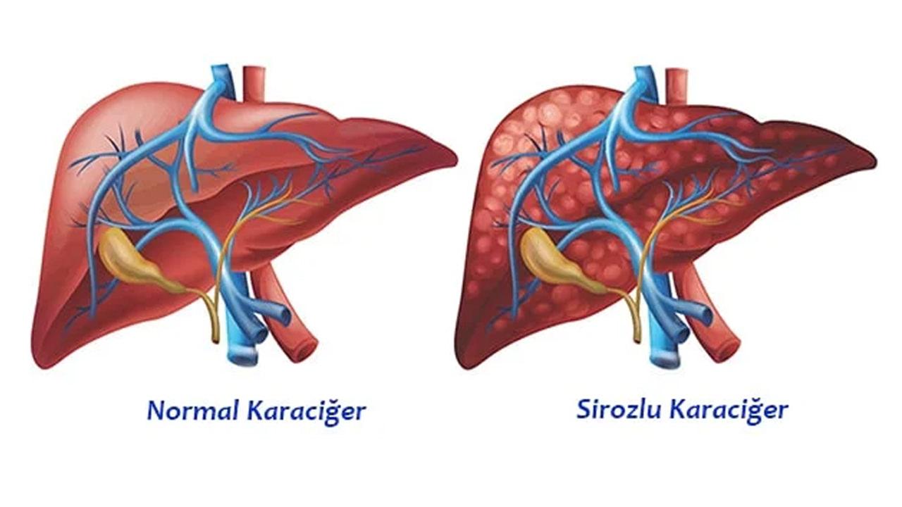 Siroz hastalığı neden olur, belirtileri nelerdir? Siroz hastalığı tedavisi var mı, ölümcül müdür?