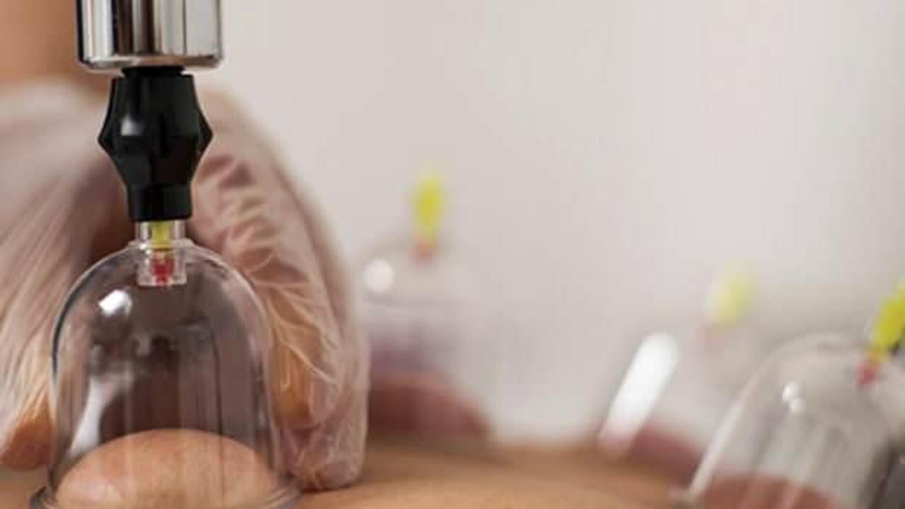 Hacamatın manevi sırları: Hacamat bölgeleri ve faydaları nelerdir? 2023 Hacamat takvimi..