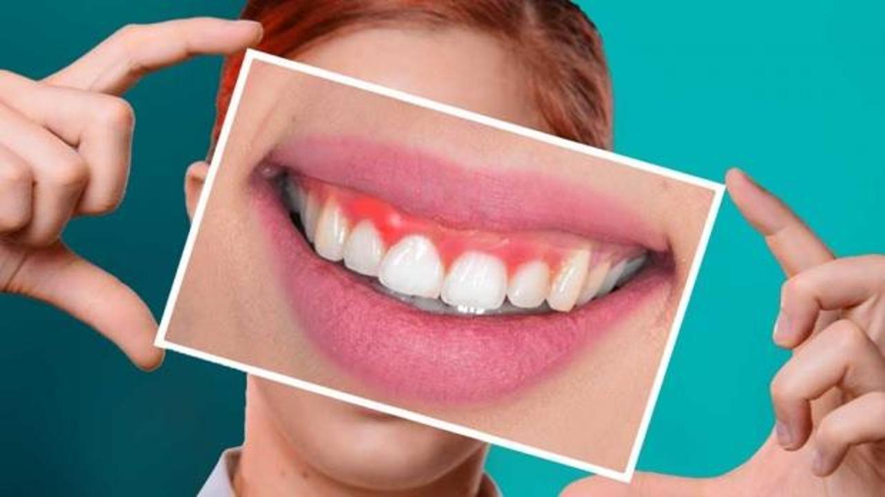 Uzmanlardan dikkat çeken diş ve diş eti problemleri uyarısı!