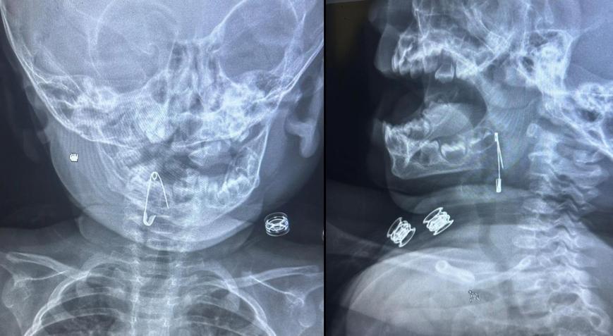 8 aylık bebeğin boğazından çengelli iğne çıkartıldı