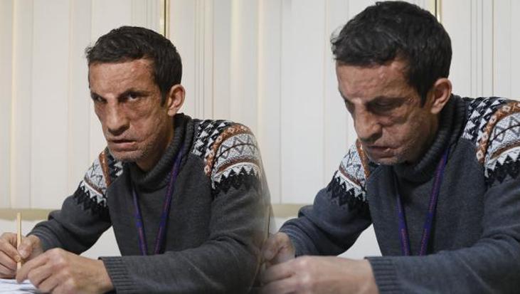 Yüz nakli ameliyatı ile yeni hayatına başlayan Uğur Acar’ın yeni hedefi