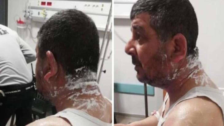 Hatay’da ev sahibi dehşeti! Kiracısına asitle saldırdı