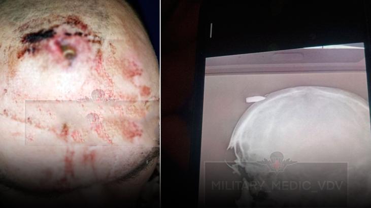 Mermi kafasına saplandı! Telegram gruplarında yayıldı, kurşun dışarıda kaldı