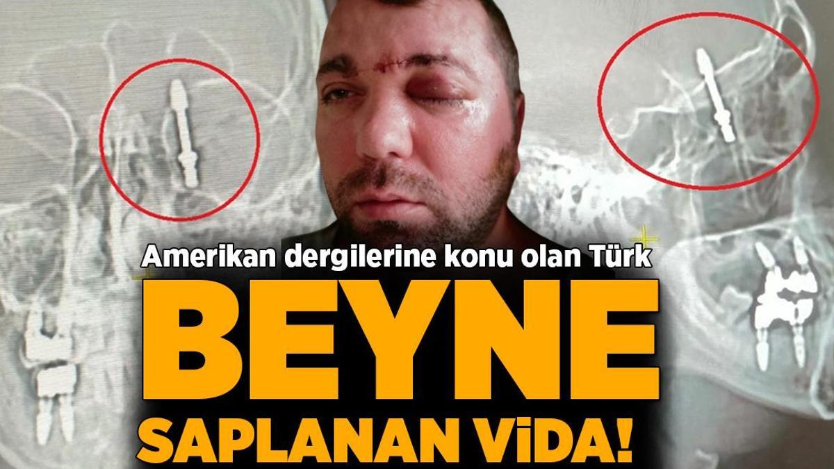 Amerikan dergilerine konu olan Türk! Beyne saplanan vida