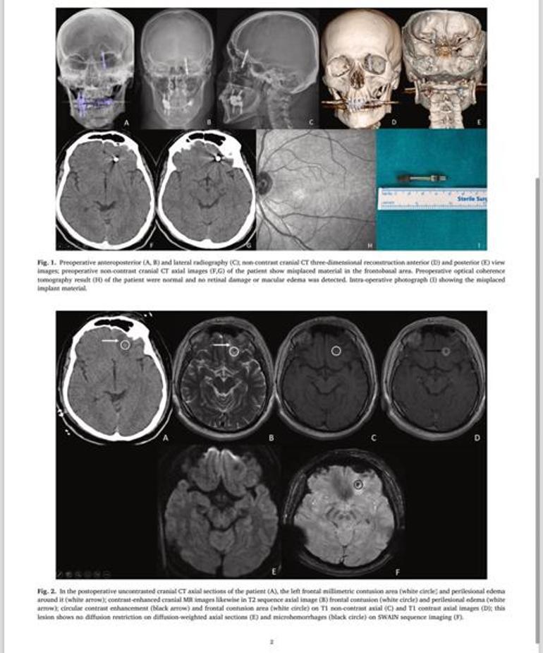 Diş implantı tedavisinde başına gelmeyen kalmadı! Yaşadıklarını anlattı