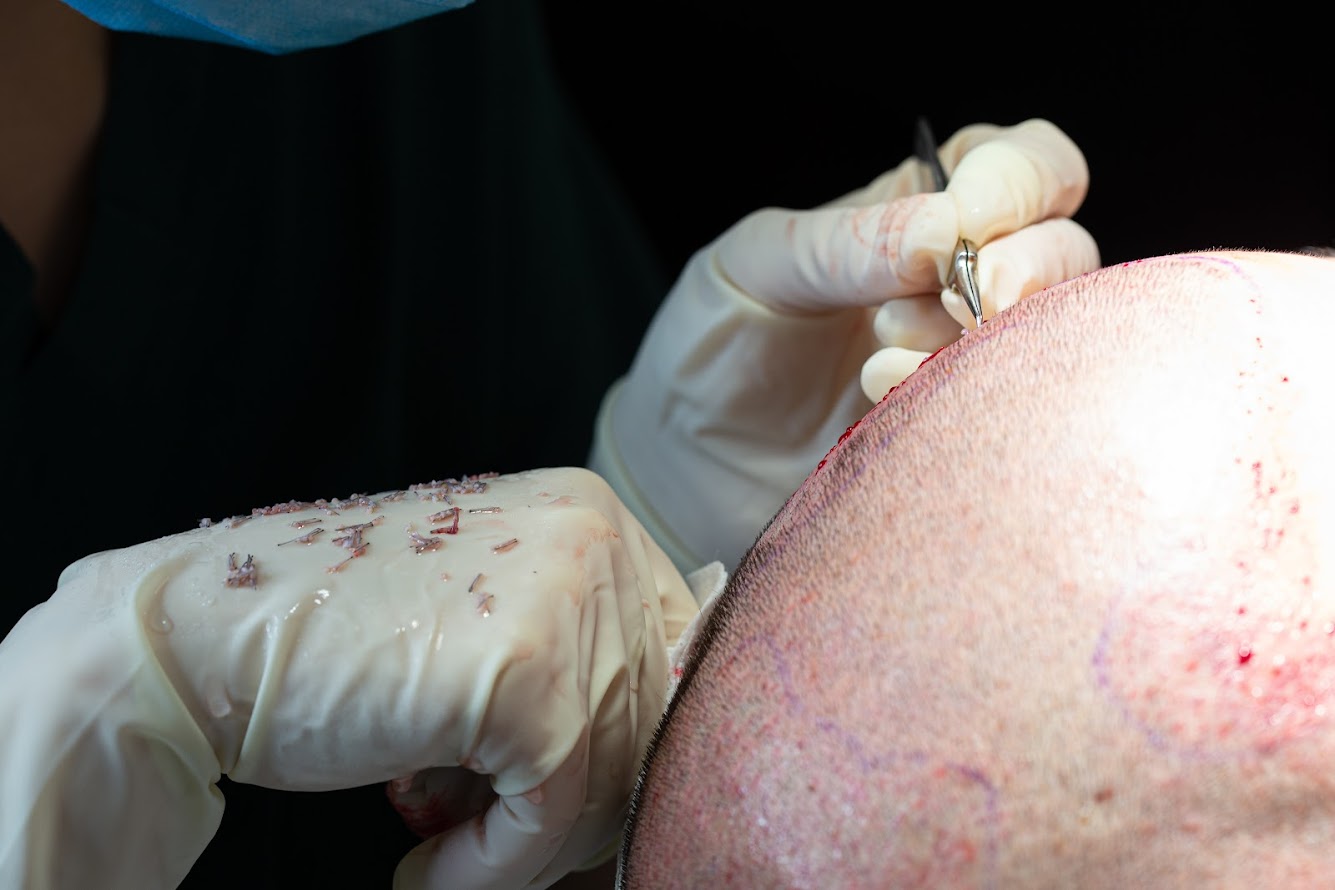 Clinista Saç Ekim Merkezi: Saç Dökülmesine Kalıcı Çözümler