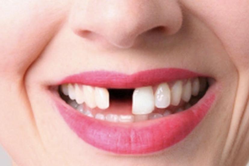 Diş eksikliği, yüz estetiğinde bozulmaya neden oluyor