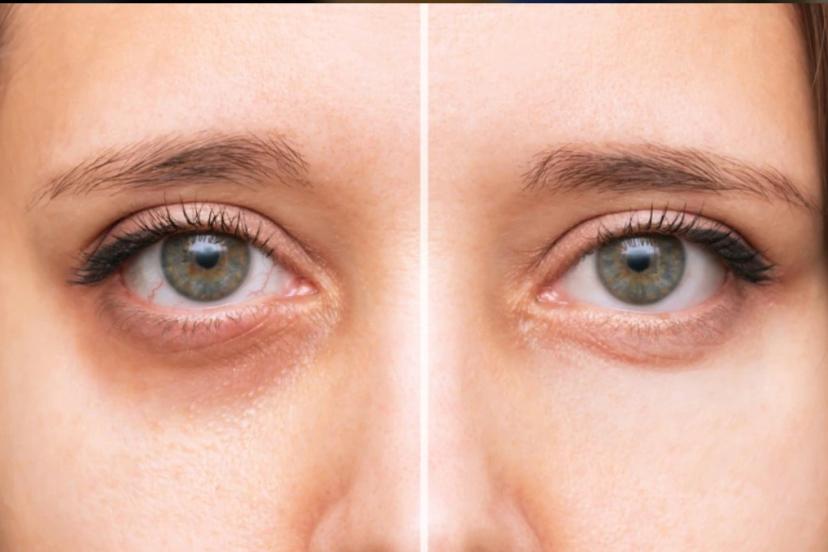 Göz altı morluklarını 1 günde yok eden formül: Dondurup sürmek şart…