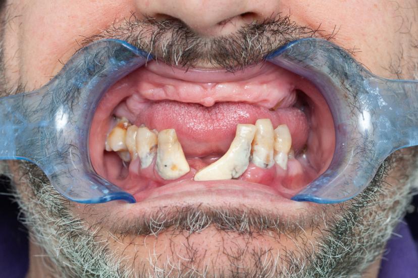 Kalp rahatsızlıklarının ardındaki sıradışı suçlu: Diş fırçalamamak