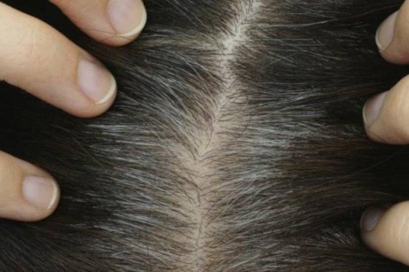Saçlarınız erken beyazlıyorsa dikkat! Bu uyarılara kulak verin!